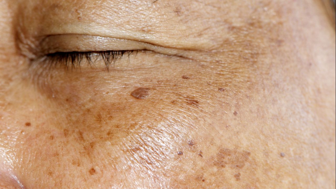 Manchas na pele: confira rotina de skincare para reduzir o Melasma
