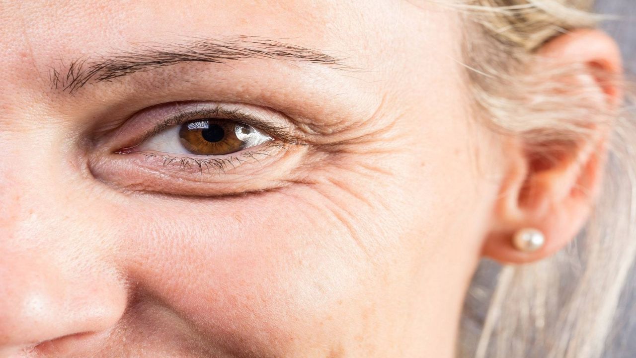 Rugas na área dos olhos: confira as principais dicas para reduzir