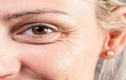 Rugas na área dos olhos: confira as principais dicas para reduzir